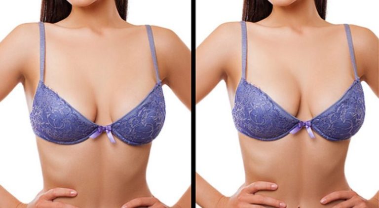 Advantages of Using Triactol For Breast Enlargement